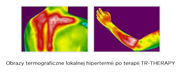 zmiany po terapii tecar zmiany po terapii tecar