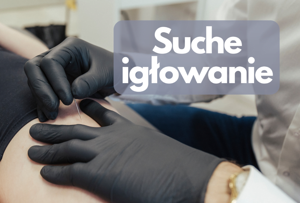 suche igłowanie Konin akupunktura